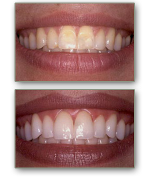 Whitening